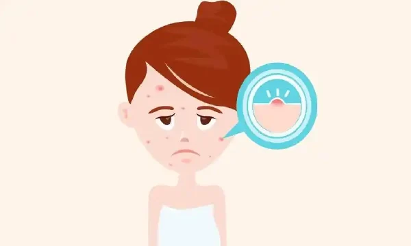 虫咬皮炎与药物治疗：关键知识知多少！