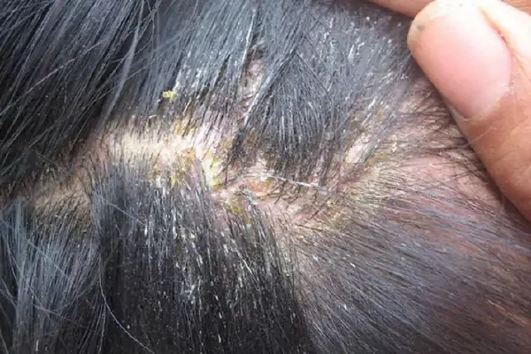 揭开脂溢性皮炎与脱发的神秘面纱