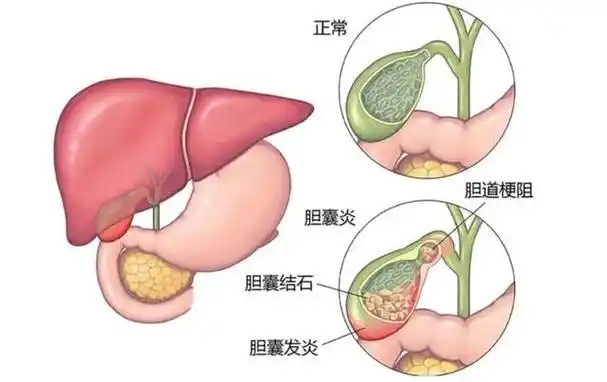了解慢性<span style="color: #da4707">胆囊炎</span>：从诊断到<span style="color: #da4707">治疗</span>