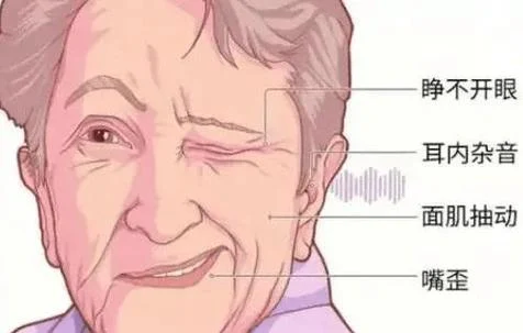 了解左侧面肌痉挛：从病因到治疗