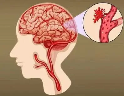 脑出血的潜在威胁&nbsp;—&nbsp;识别、治疗与预防