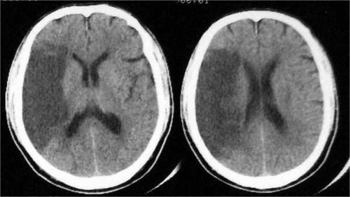 多发腔隙性脑梗死的临床诊断与管理