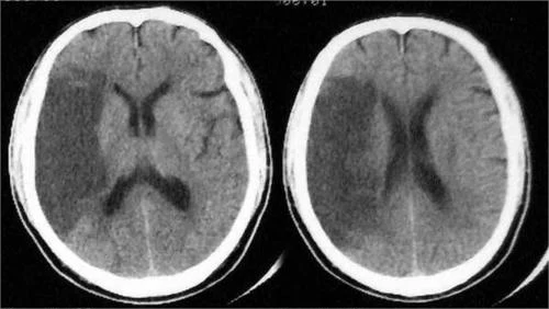 多发腔隙性脑梗死的临床诊断与管理