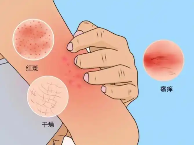 皮炎与荨麻疹，你需要了解的全部信息！封面图