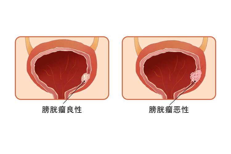 膀胱恶性肿瘤的多层次解读与管理