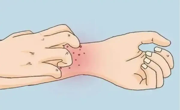 湿疹：你需要了解的一切