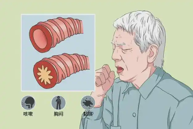 谨防急性下呼吸道感染：从根本预防到科学治疗的全攻略