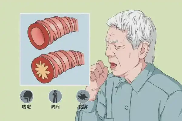 谨防急性下呼吸道感染：从根本预防到科学治疗的全攻略