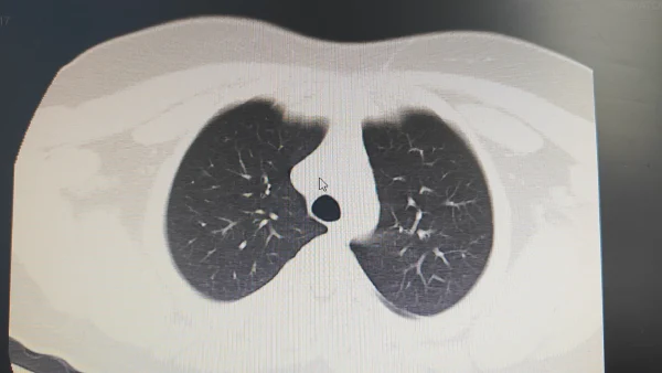 肺水肿警报——深呼吸可能都成了奢望!