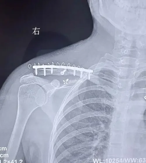 锁骨骨折与肩胛骨骨折综合管理指南 - 健康科普、医学科普、中医科普、儿童科普、科普中国