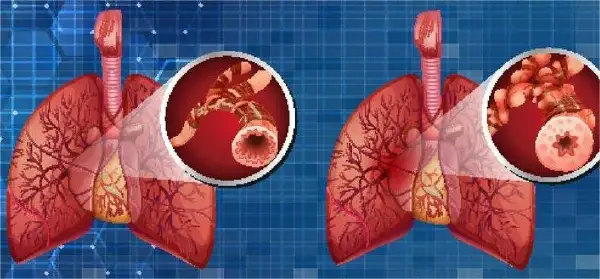 慢性阻塞性肺病(COPD):从病因到治疗的全面解读