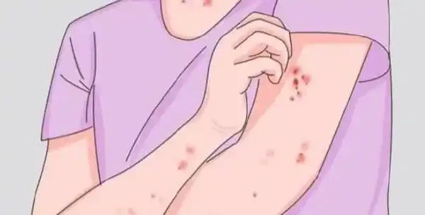 湿疹复发困扰您吗？一起来了解解决办法吧！