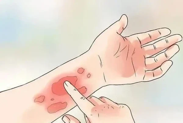 慢性荨麻疹——时刻关注你的皮肤健康!