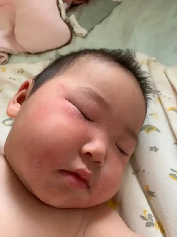 儿童湿疹大揭秘:宝宝皮肤不适应对大作战!