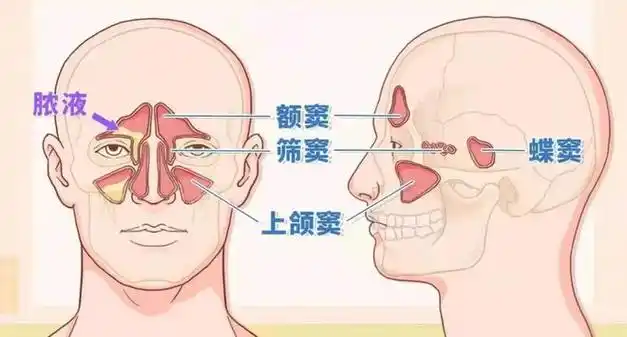 慢性鼻窦炎和鼻息肉：你需要了解的细节！