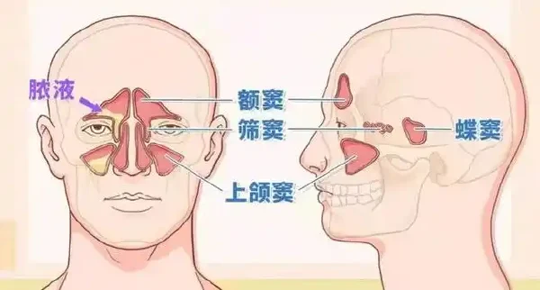 慢性鼻窦炎和鼻息肉:你需要了解的细节!