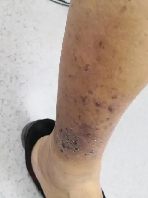 过敏性皮炎：你需要了解的一切