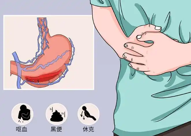 全面解析急性上消化道出血：预防与治疗尽在掌握封面图
