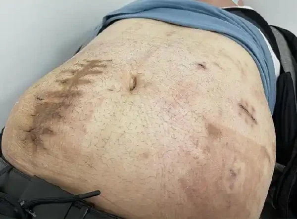 关于腹壁切口疝的全面综述：诊断、分期与治疗