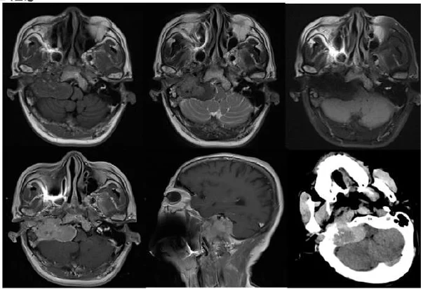 了解桥小脑角区病变:从诊断到治疗