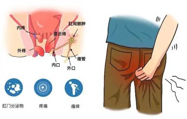 肛瘘，你有听说过吗？——了解原因、症状及预防措施封面图