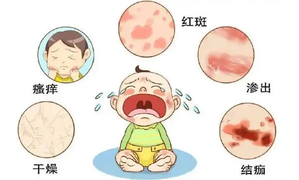 湿疹与过敏:从药物治疗到生活管理