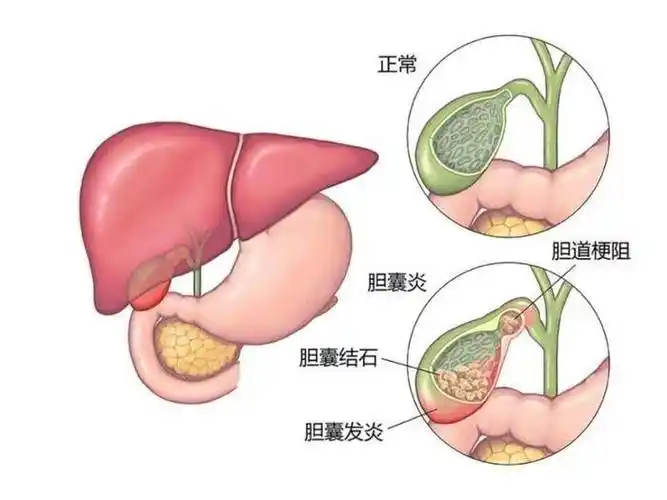 全面了解胆囊结石的诊断与治疗封面图