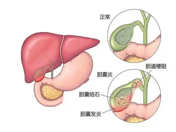 全面了解胆囊结石的诊断与治疗