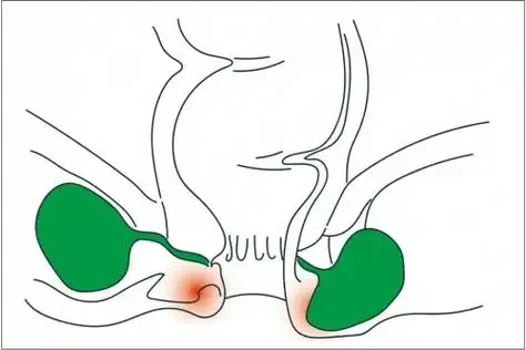 肛周脓肿的诊断与治疗