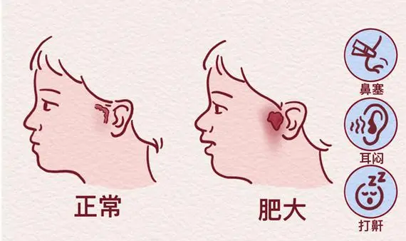 儿童鼾症与腺样体肥大综合诊疗指南