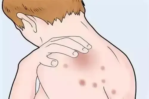 头发与皮肤问题:神经性皮炎与脱发!了解并预防,健康才是关键