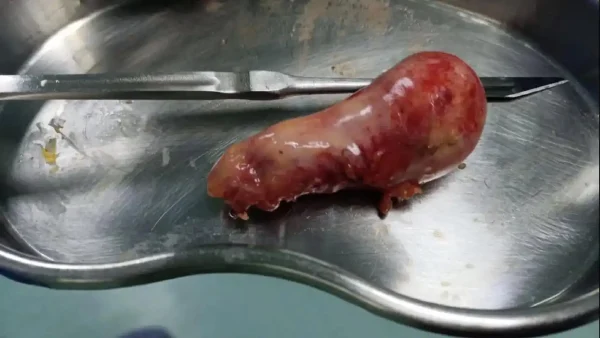 胆囊结石伴胆囊炎的诊断与治疗：从基础知识到临床实践