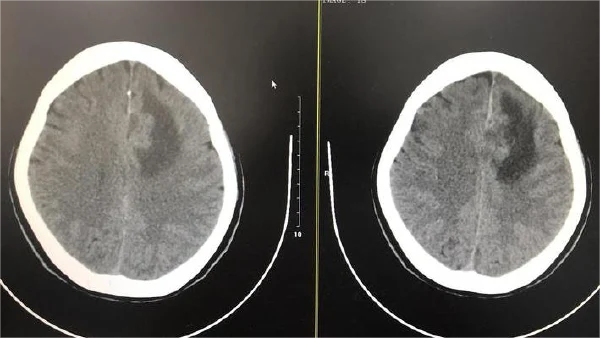 全面解析镰旁顶叶占位病变：从诊断到治疗