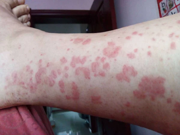 过敏性紫癜和湿疹:你需要了解的关键点