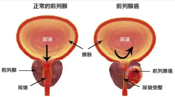 前列腺增生的诊断与治疗全面解析