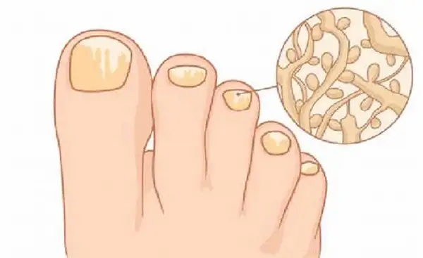 灰指甲:小病不小,看它如何影响你的生活