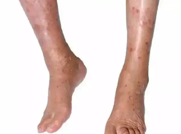 湿疹让你抓狂？了解湿疹，从防治开始！