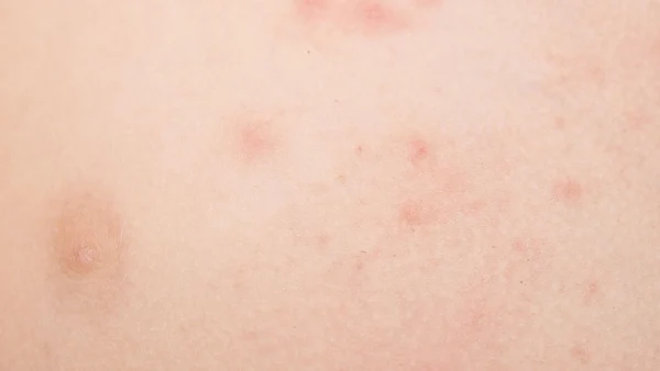 全面了解急性荨麻疹:症状、治疗及预防