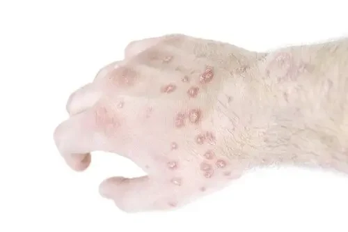 皮肤过敏的隐匿杀手——过敏性皮炎!