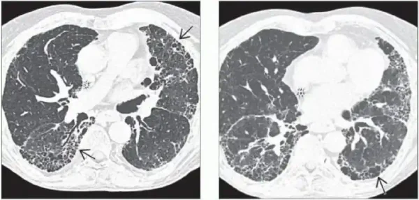 矽肺的全面解析：疾病类型、诊断、分期及治疗
