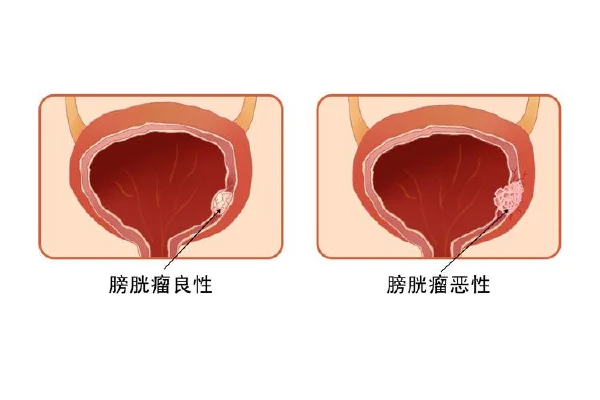 揭开膀胱肿瘤的神秘面纱——生命的隐形威胁！