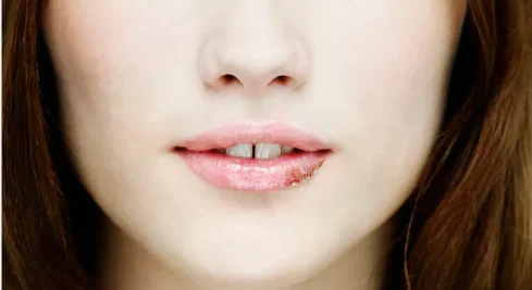 揭开口角炎的面纱：为什么我们会得“烂嘴角”？