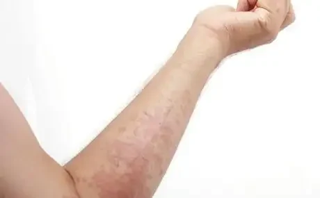 过敏性皮炎：小小皮肤问题的巨大影响