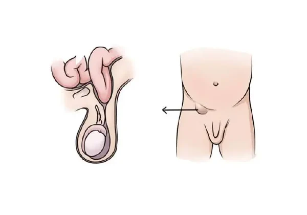 突发腹部疼痛?了解右侧腹股沟疝与肠梗阻