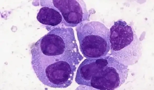 多发性骨髓瘤：隐形杀手！你必须了解的致命真相