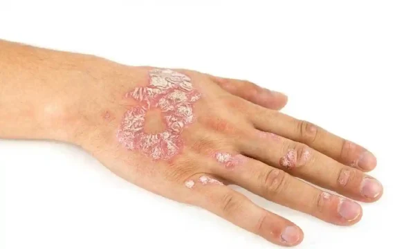 远离皮炎与银屑病:儿童也要健康皮肤计划