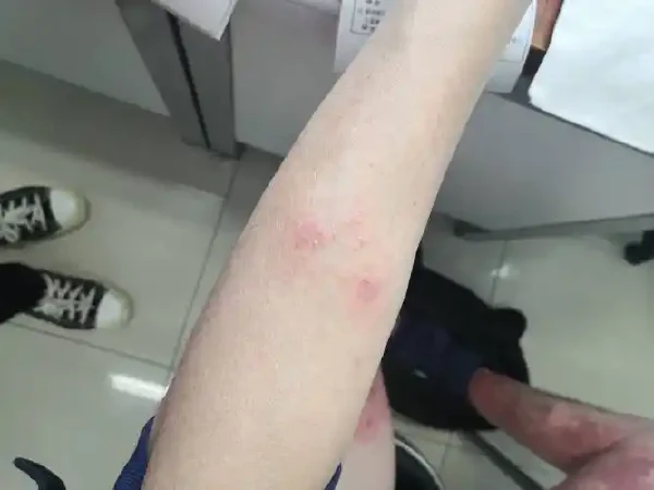 湿疹:病因、诊疗与管理全解析