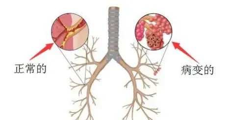 慢性支气管炎:全面了解与科学管理