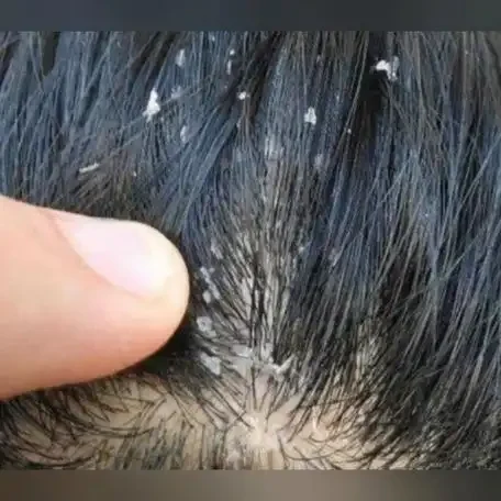 小心皮肤敌手:破解皮肤真菌感染与脂溢性皮炎的谜团