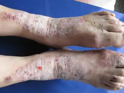 过敏性皮炎，你了解多少？——从日常护理到专业治疗，一篇权威指南让你知无不言！封面图
